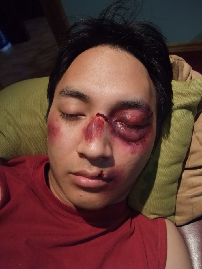 jericho-black-eye-and-beaten-up.jpg