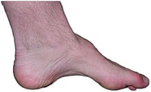 220px-Charcot-marie-tooth_foot.jpg