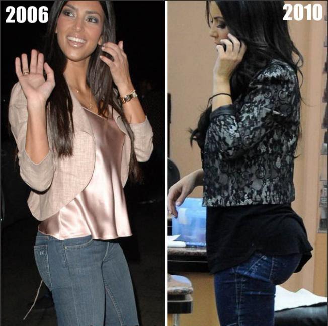 kim-kardashian-butt-augmentation.jpg