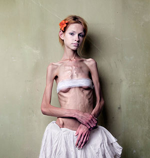 anorexic.jpg