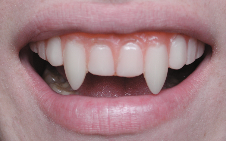 vampire-teeth.jpg